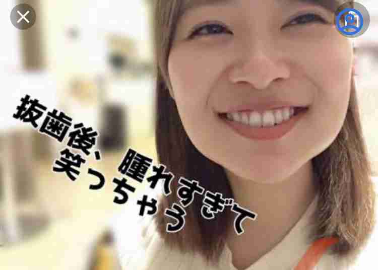 「親知らずを4本抜いた時の俺」　ヤバすぎる腫れ方に30万人の腹筋が崩壊