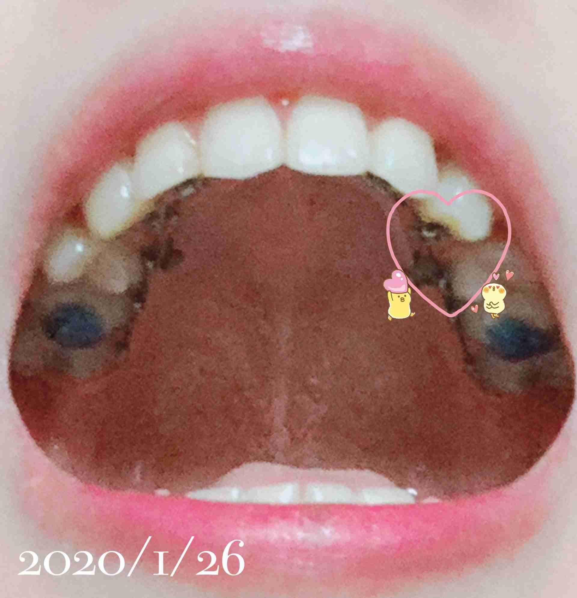 裏側矯正の経験者さんいますか！