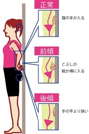 反り腰を治したい！