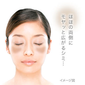 肝斑をなくしたい