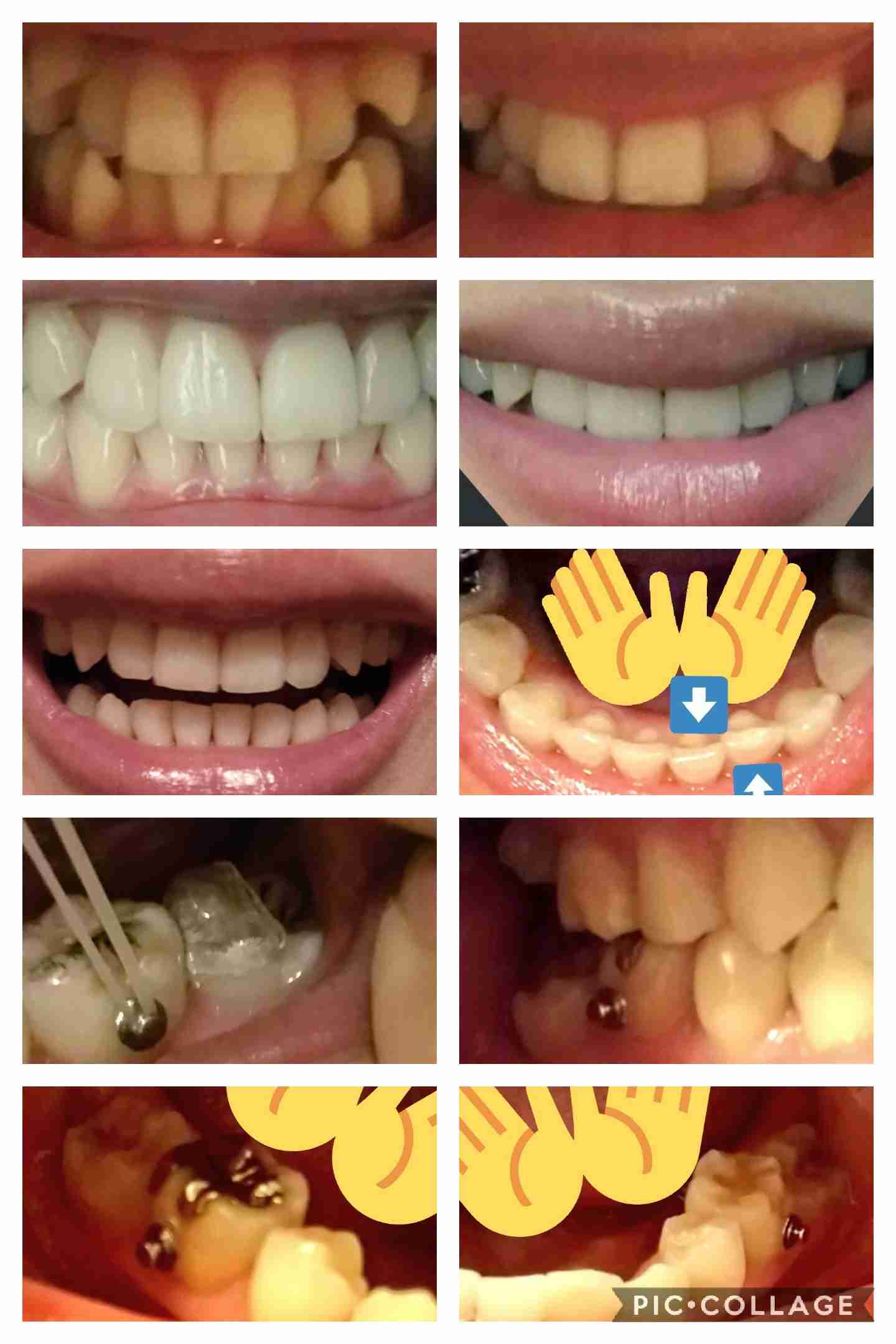 30歳以上で始める歯科矯正