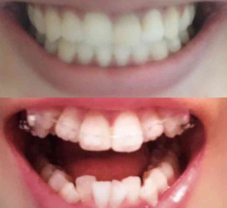 30歳以上で始める歯科矯正