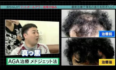 抜毛症の方〜〜!
