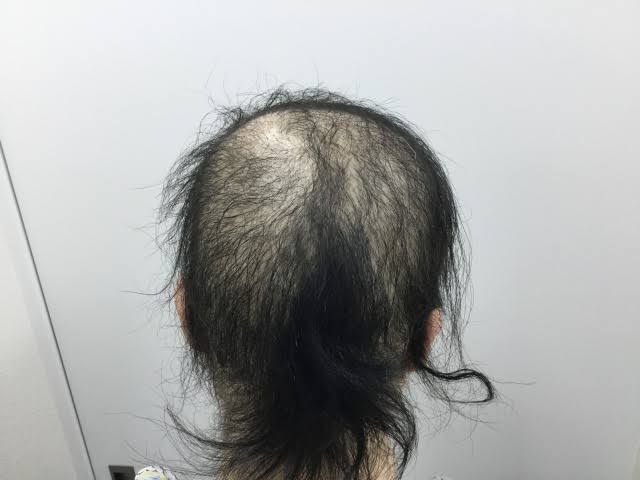 抜毛症の方〜〜!