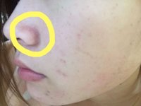 脂漏性皮膚炎のベースメイク
