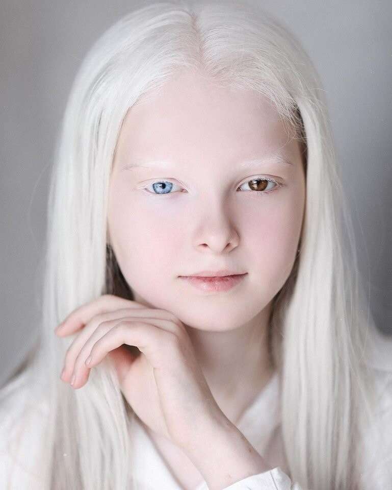 瞳の色がブルー＆ブラウン　神秘的な美しさを持つアルビノの11歳少女（露）