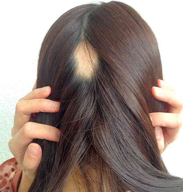 ストレスと髪の毛の関係