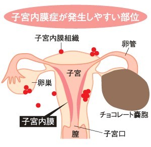チョコレート嚢胞の方いますか??