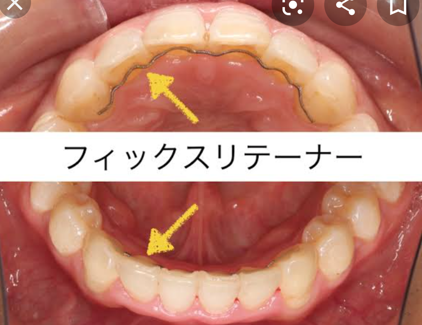 歯列矯正の後戻り【悲しい】