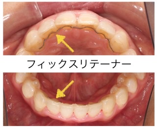 歯列矯正の後戻り【悲しい】