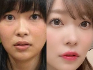 【目袋】旦那に整形を反対されている方【取りたい】