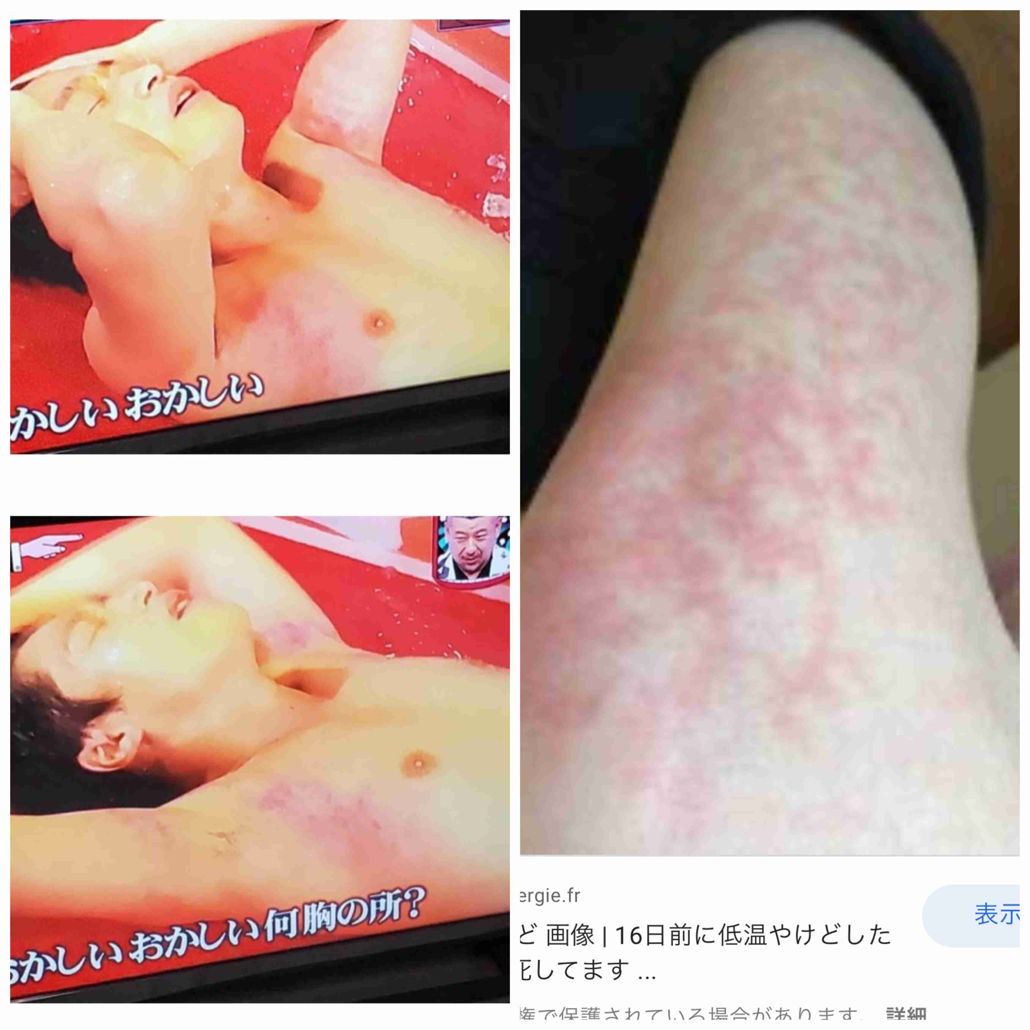 松本人志もドン引き…『水ダウ』熱湯風呂で団長が“やけど騒動”
