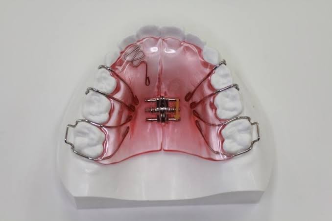 子供の歯の矯正