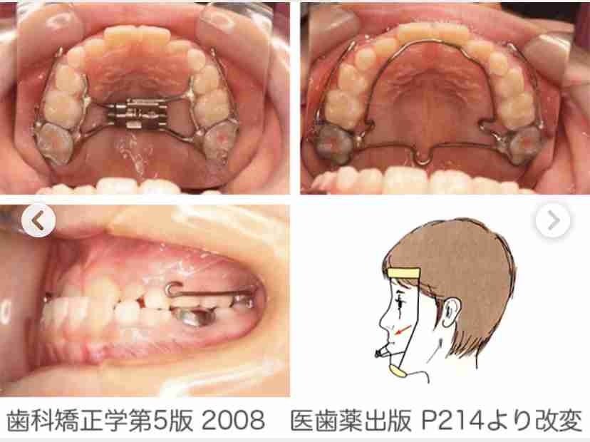 子供の歯の矯正