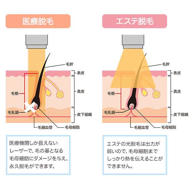 医療脱毛してよかったと思うこと