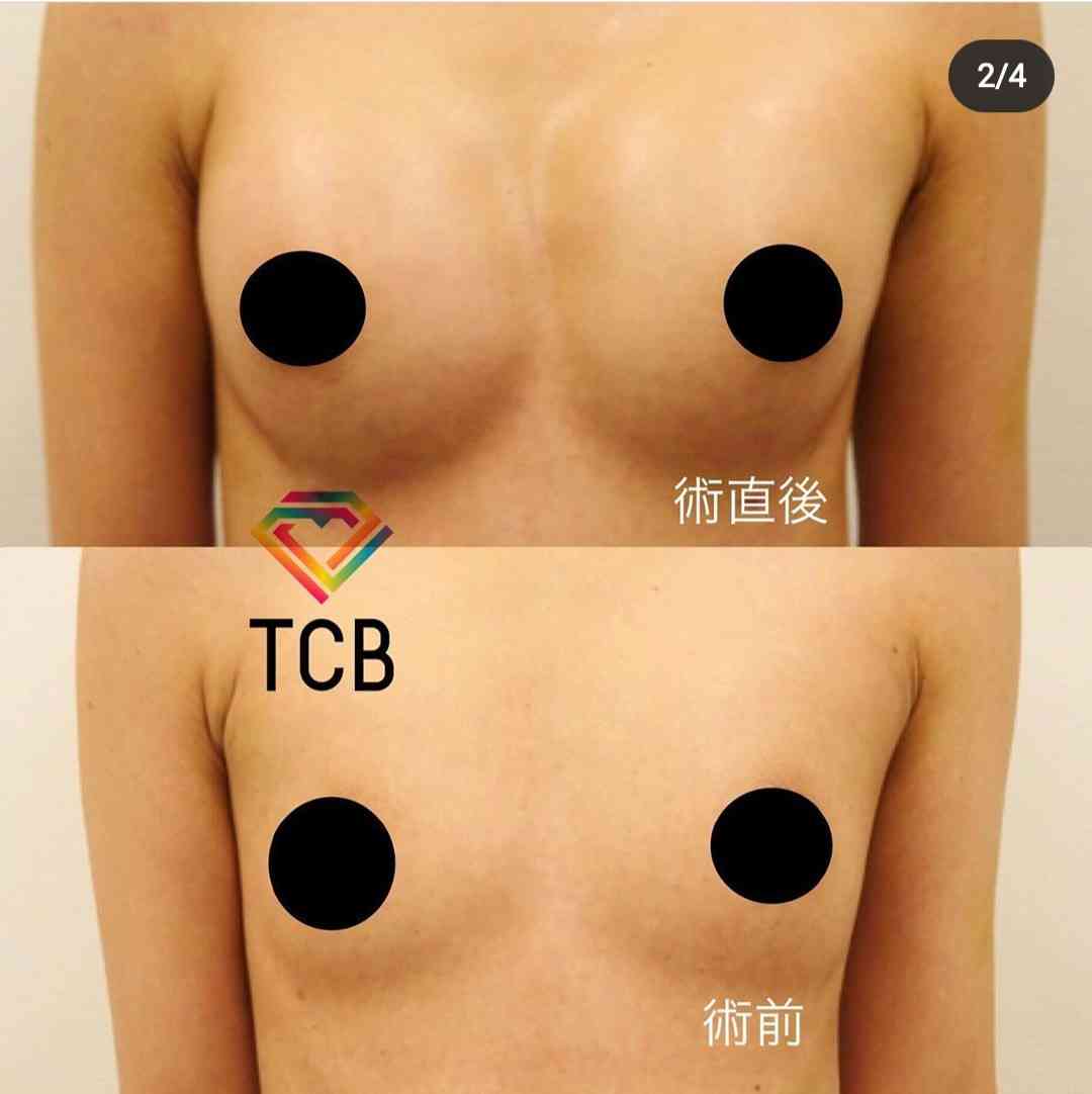 トルコで豊胸手術を受けた女性、乳首が壊死してポロリと落ちる（英）