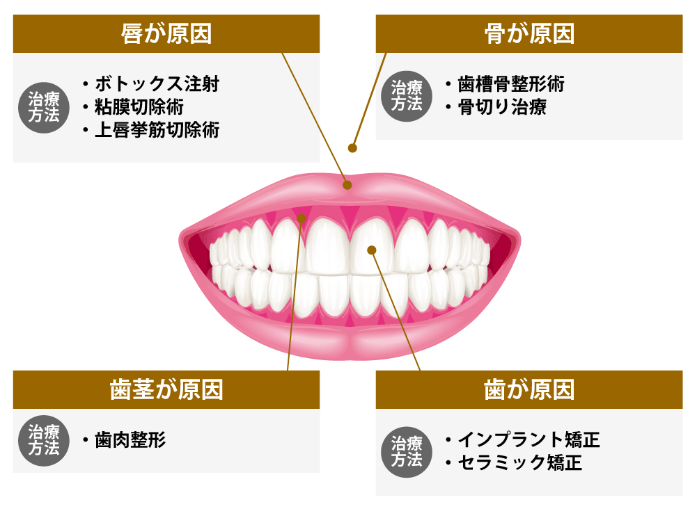 ガミースマイルについて ガールズちゃんねる Girls Channel