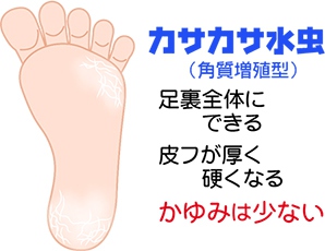 足の裏が汚い
