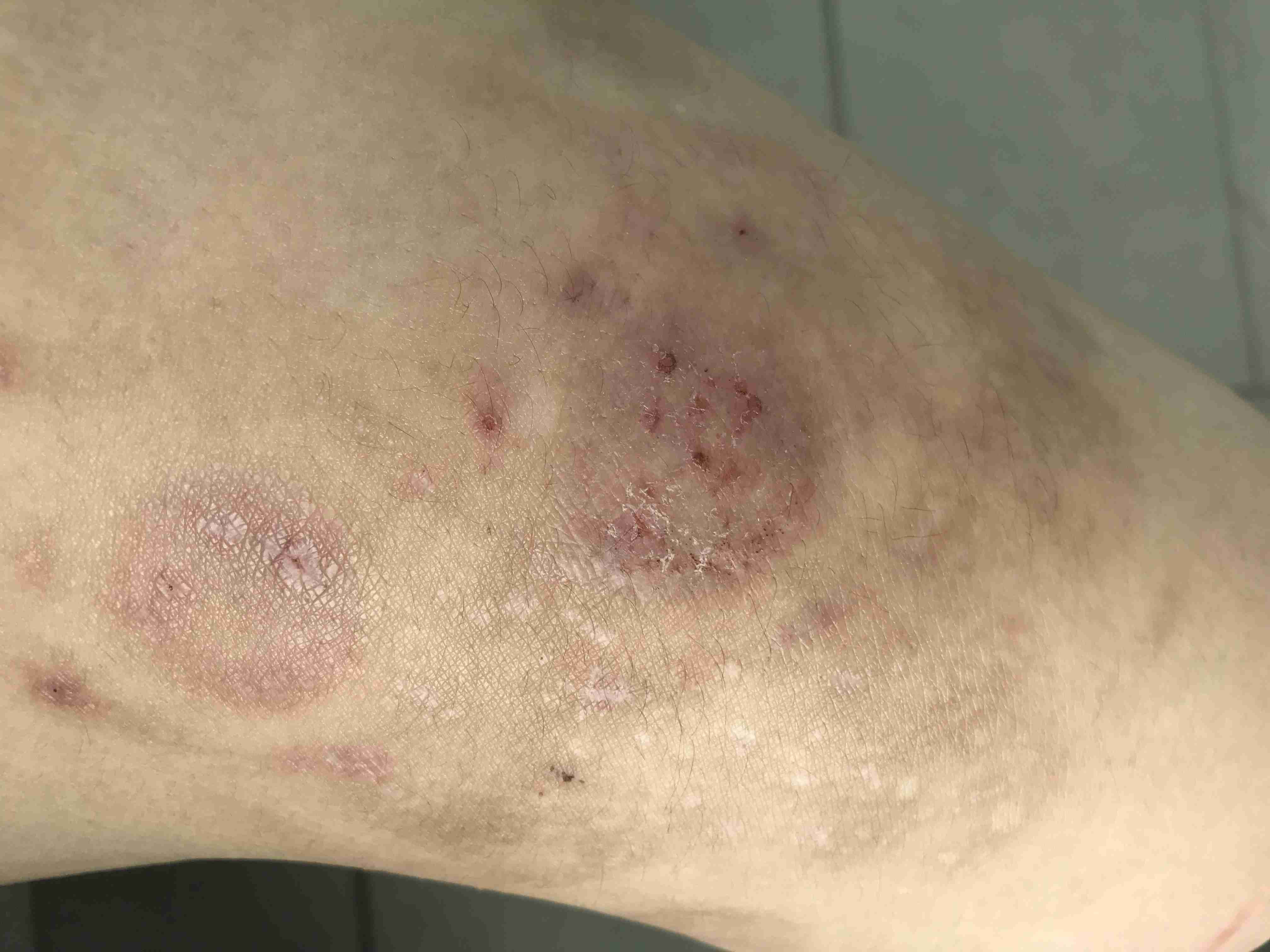 1型糖尿病を患っている方とお話がしたいです
