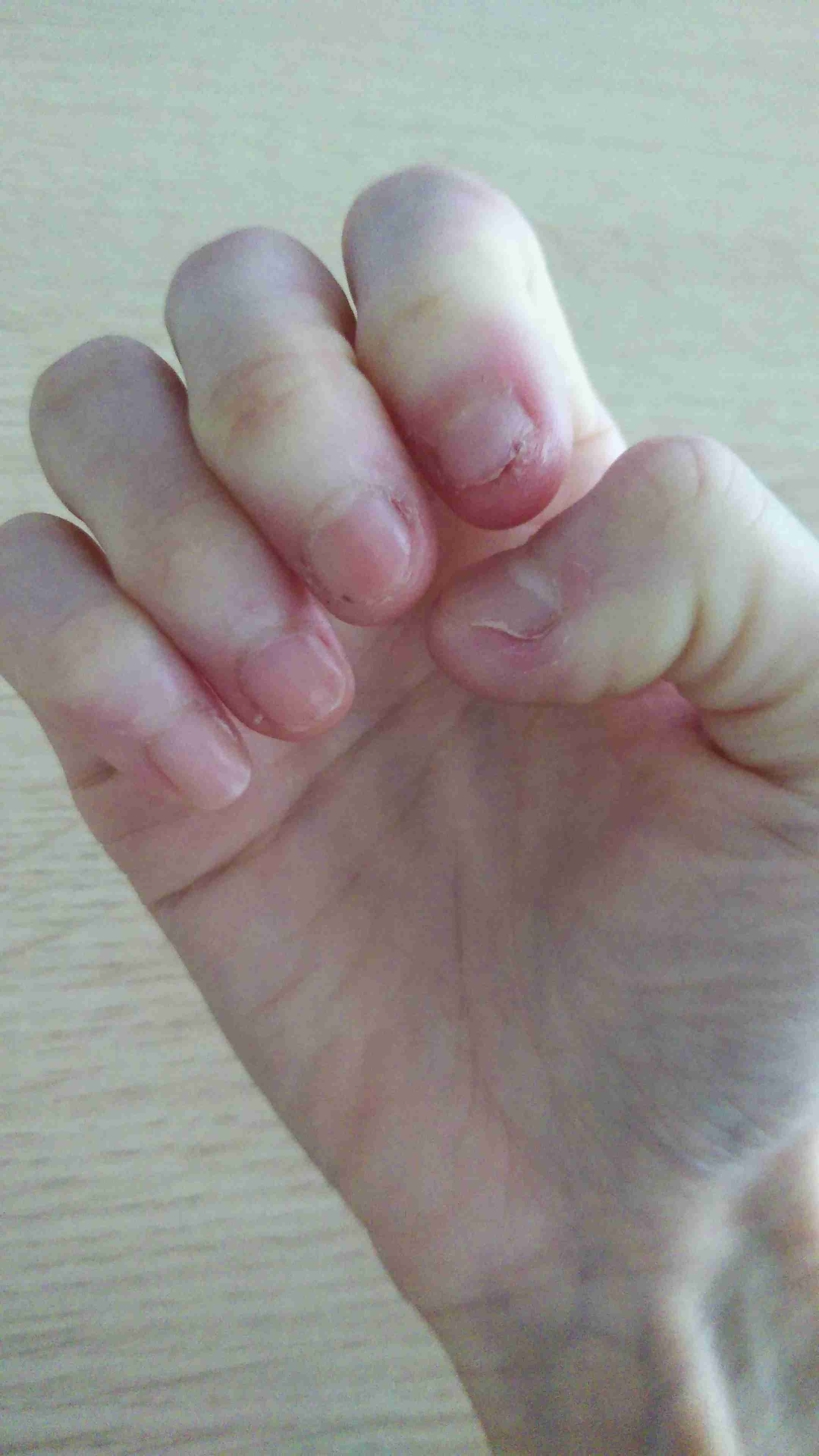 励まし合って自爪を伸ばすトピ
