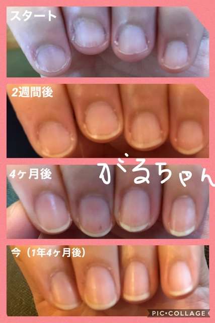 励まし合って自爪を伸ばすトピ
