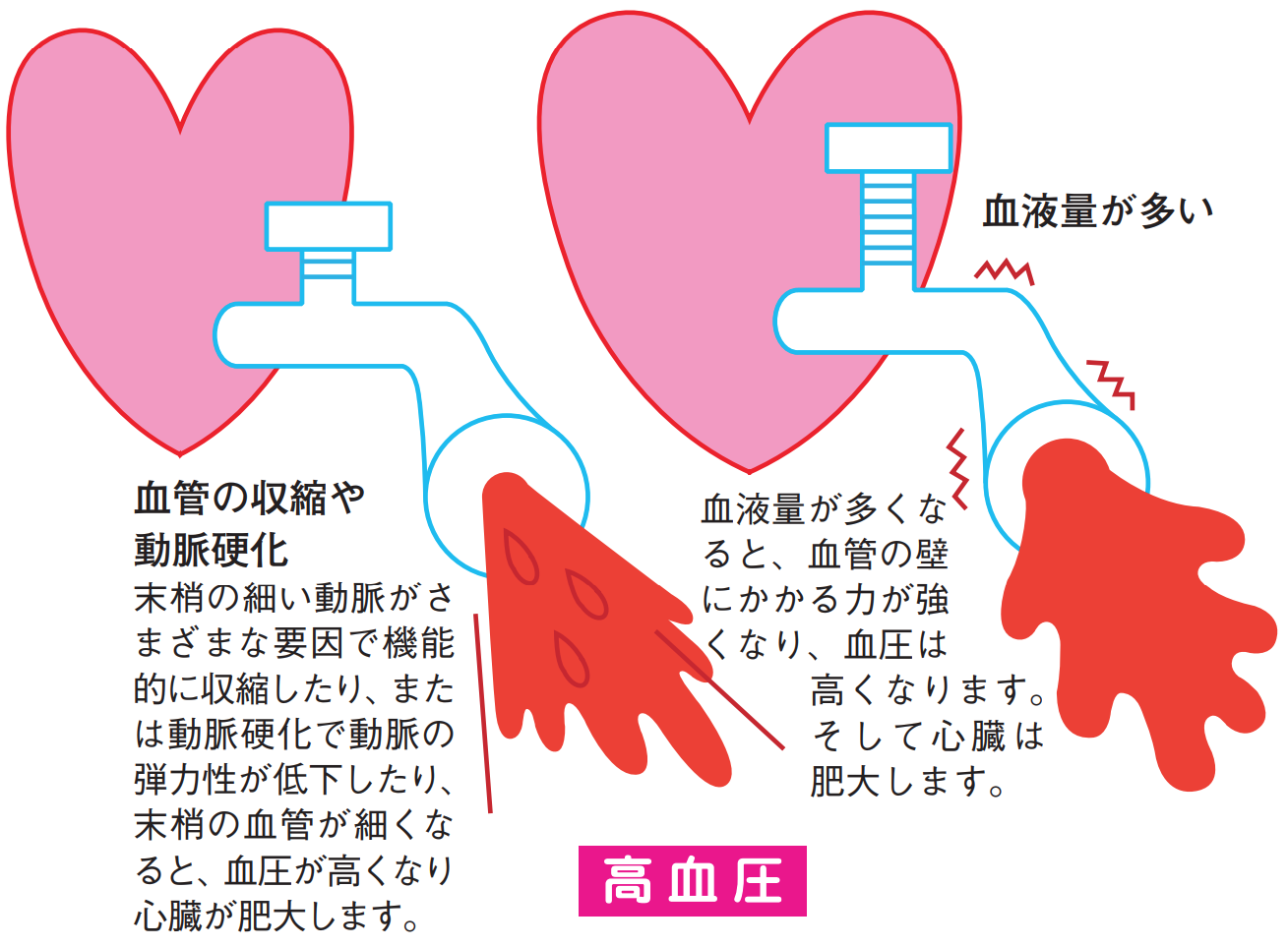 高血圧の人、高血圧だった方
