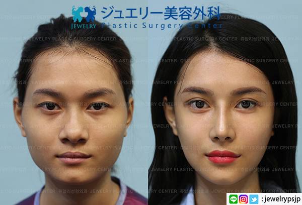 整形で失敗する人と成功する人の違い