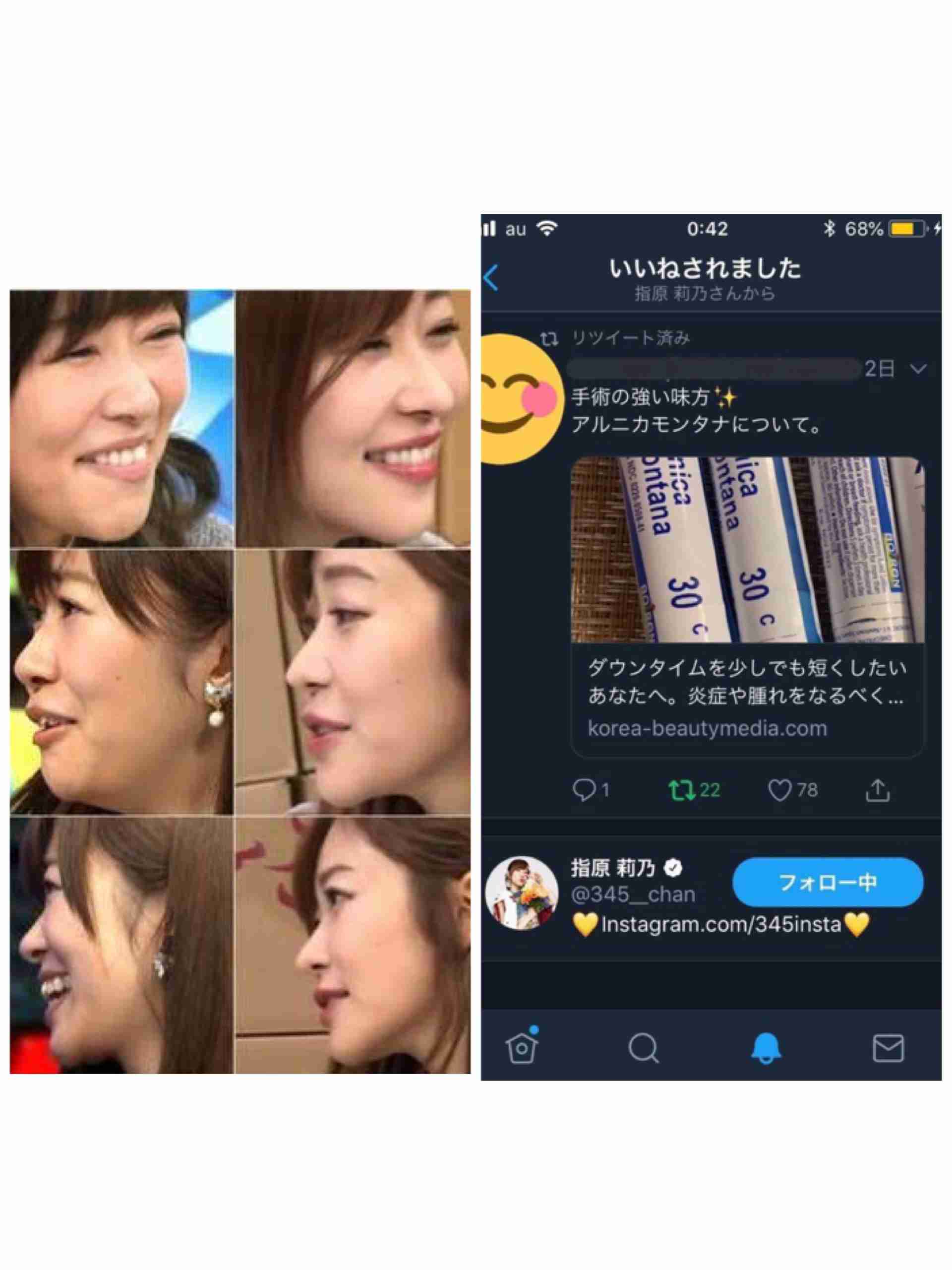 指原莉乃、顔や唇の腫れ告白「恐らくクインケ浮腫」フォロワーから「わたしも…」「早く良くなって」