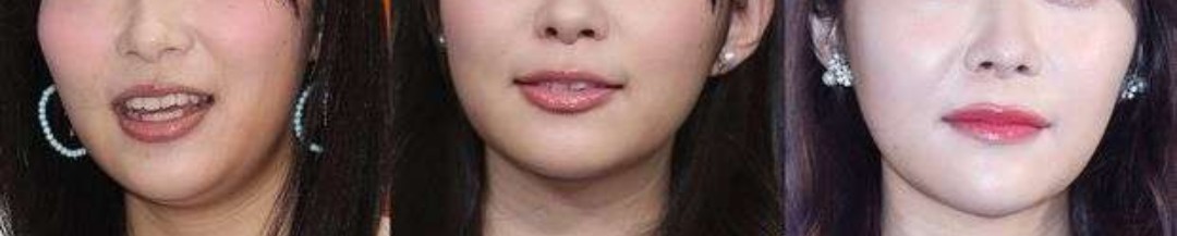 指原莉乃、顔や唇の腫れ告白「恐らくクインケ浮腫」フォロワーから「わたしも…」「早く良くなって」