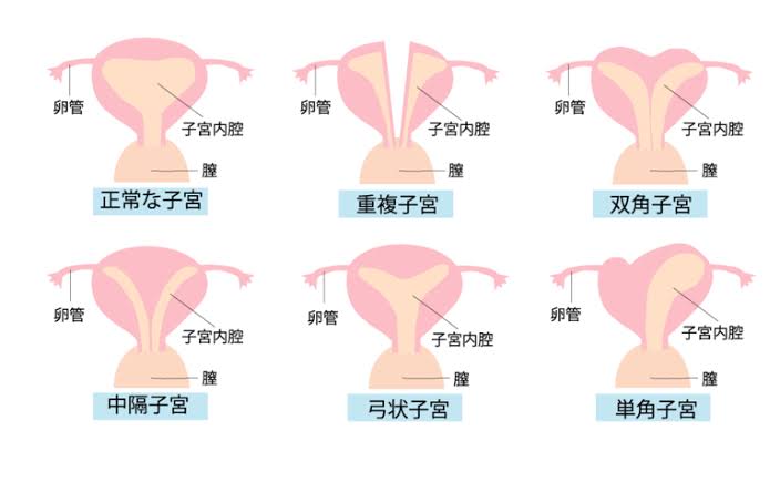 2つある子宮で同時に妊娠した女性　世界4例目の三つ子を出産