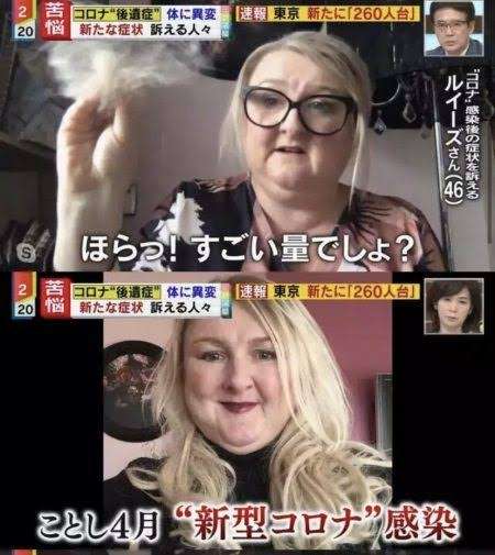 新型コロナ感染の30代女性 後遺症の脱毛で頭頂部はまばらに…「外に出るのもつらい」