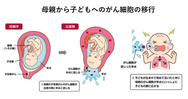 母の子宮頸がん、子に移行　羊水に混入、肺がんに―世界初・国立がん研究センター