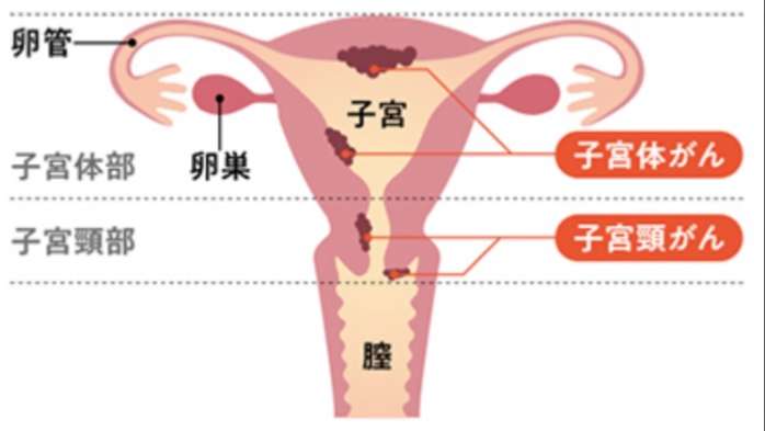 子宮体癌検査受けたことのある方