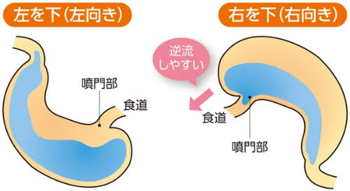 逆流性食道炎がつらい人