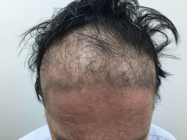 抜毛症の方お集まり下さいませ。
