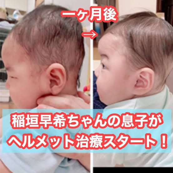 子どものヘルメット治療について語りたい ガールズちゃんねる Girls Channel