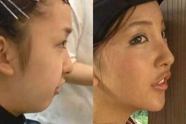 彼氏や旦那に整形を告白した人！