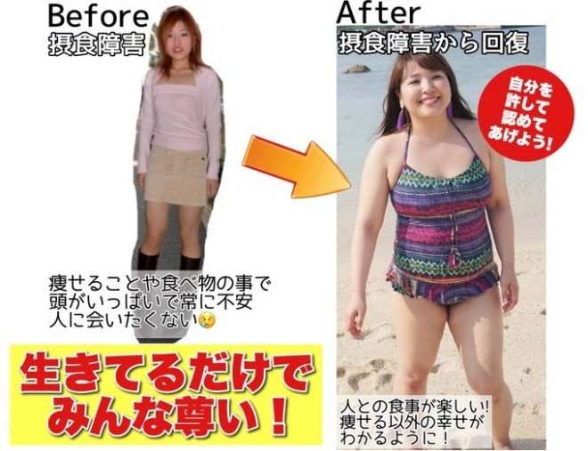 摂食障害が原因で人生変わった人いますか?