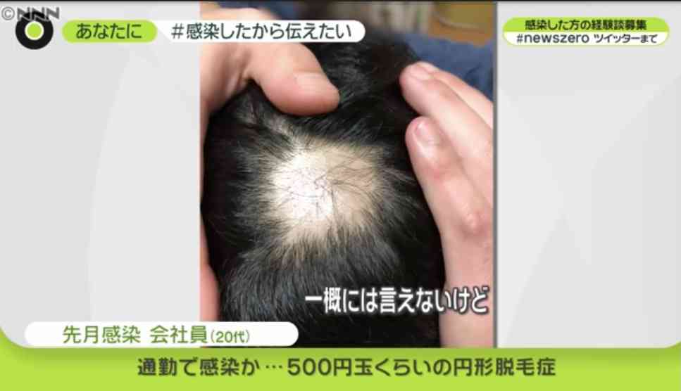 コロナにかかった事ある方Part2