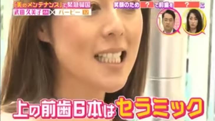 セラミックの歯について語りたい