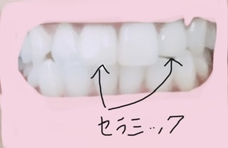 セラミックの歯について語りたい