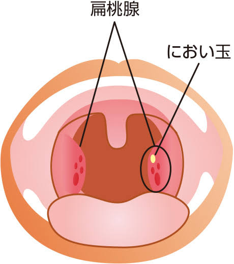 ヒステリー球がある人