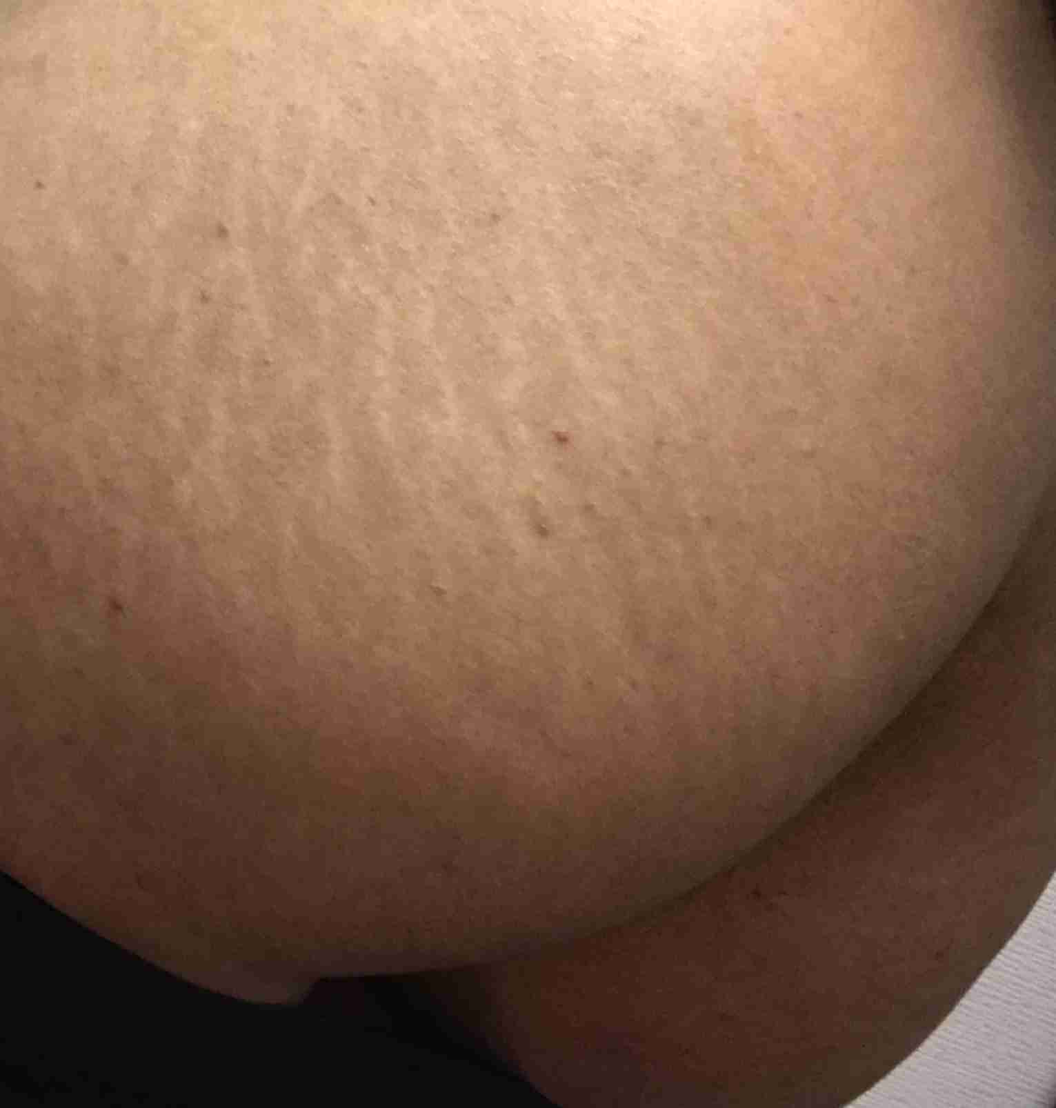 マスクで肌荒れ