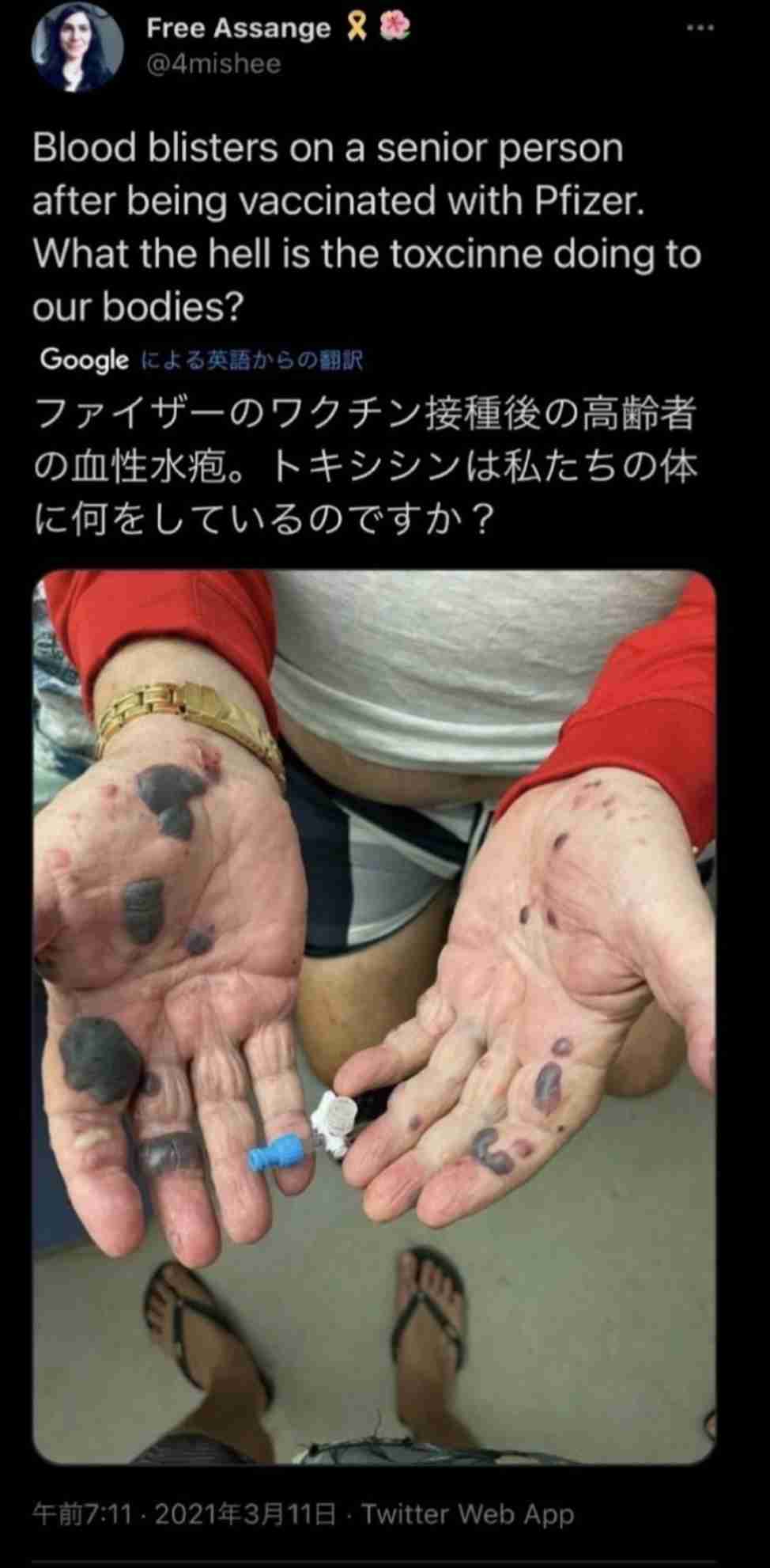 ワクチン打つ前に準備しておくこと