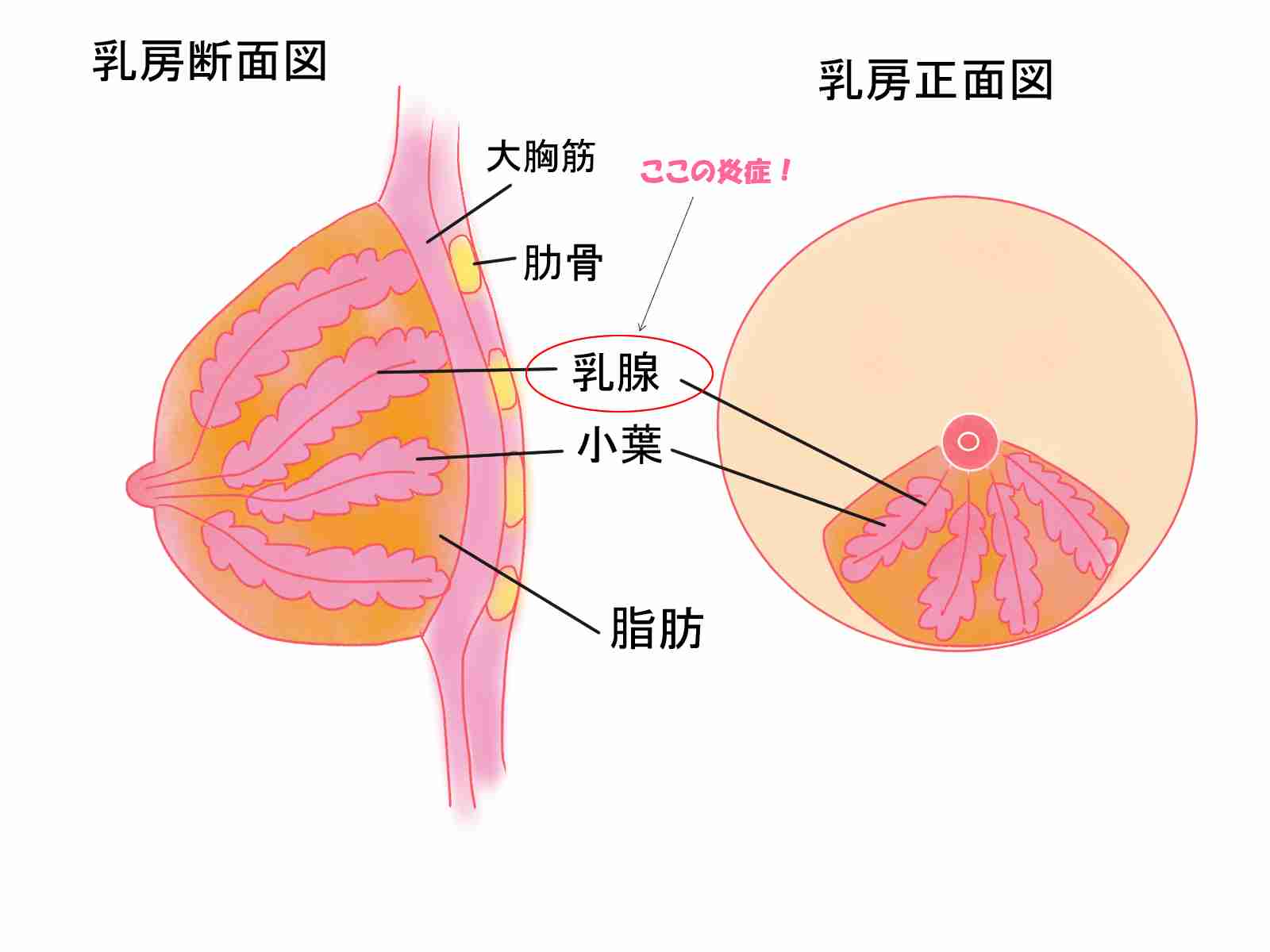 乳腺炎
