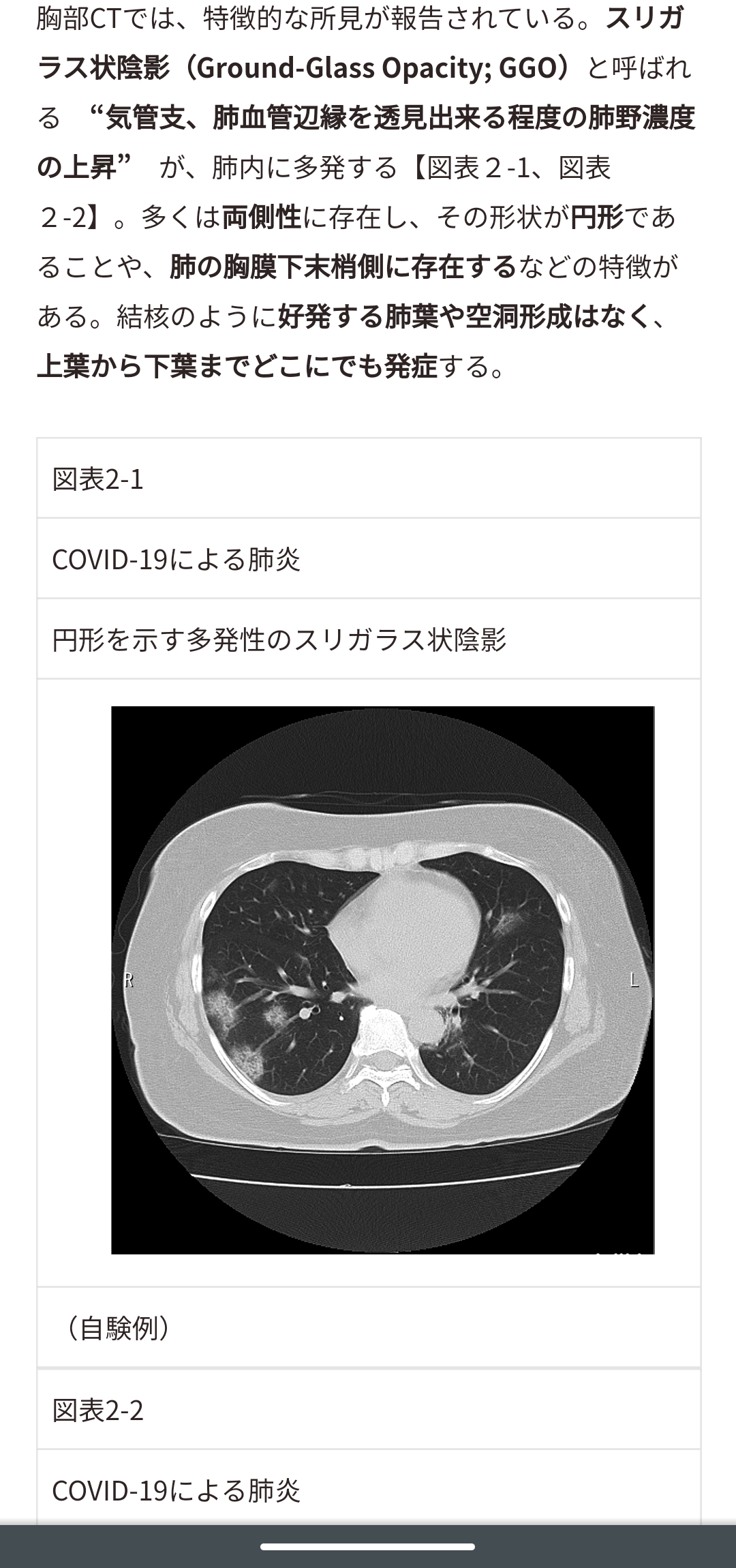 コロナ発症から退院までの3週間「30代・基礎疾患なしでも地獄の日々」