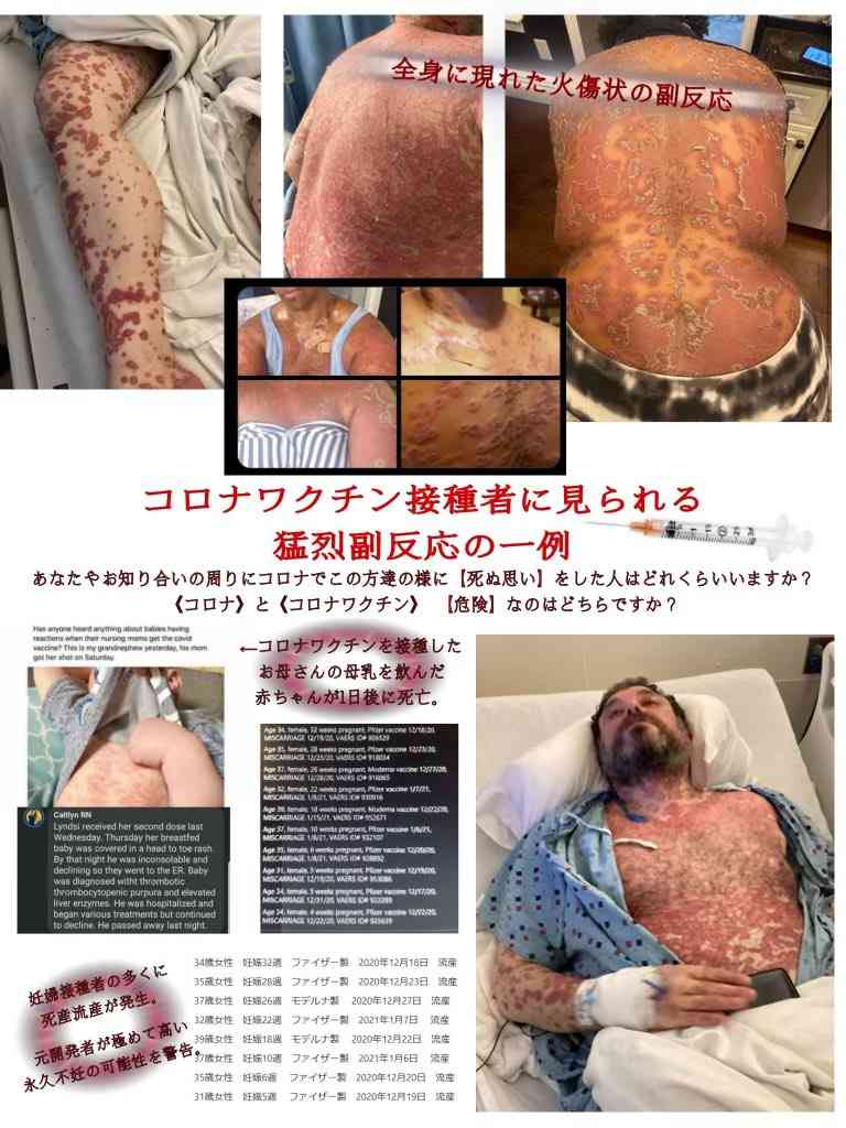 七つの変異株「9割以上無力化」横浜市大、ワクチン接種者の抗体解析