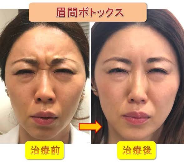 眉間のシワを無くしたい