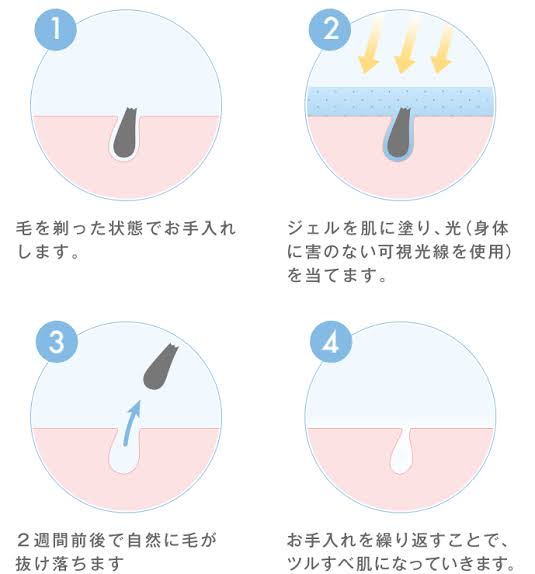 医療脱毛で何か問題が起きたことがある方