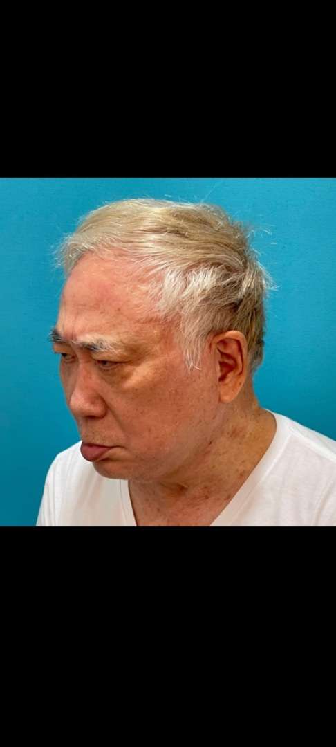 高須克弥院長、がん治療後即整形手術　眉と鼻下「クリニック若返り技術を見せる」